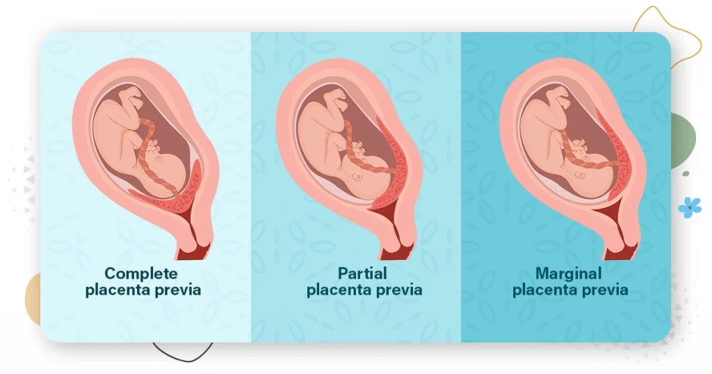 Diagnosis of placenta -different types