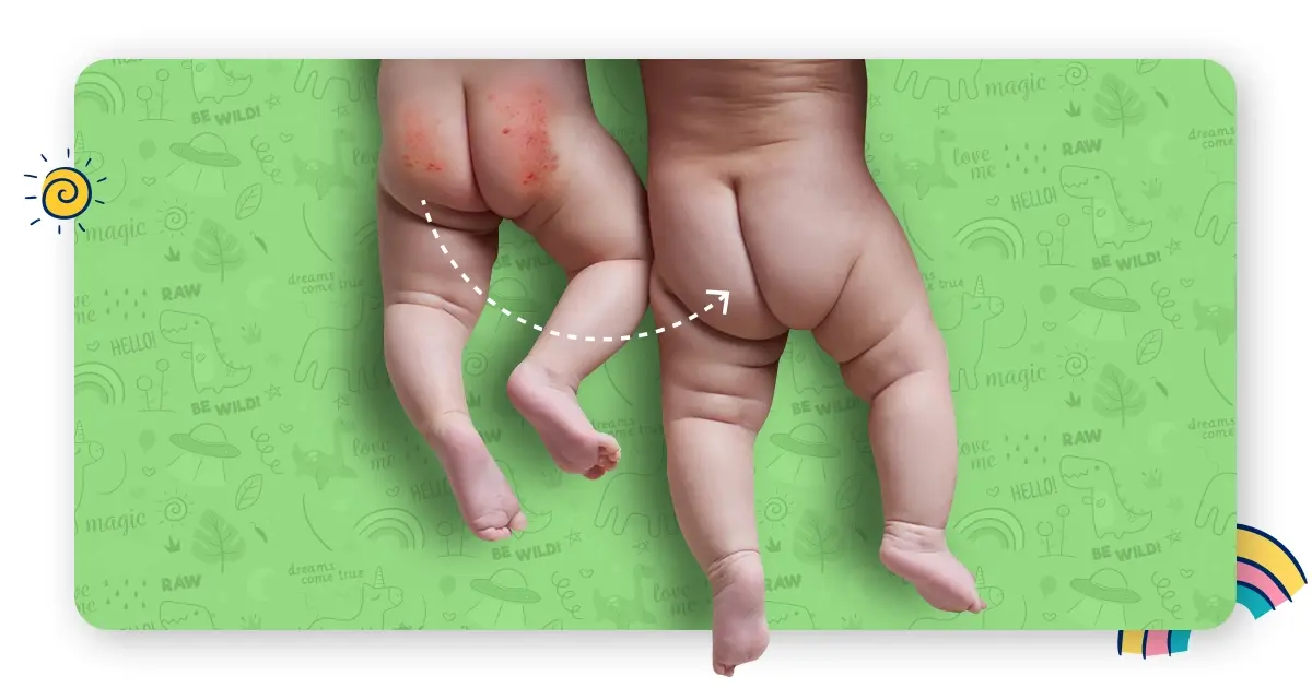effective home remedies for diaper rashes in babies